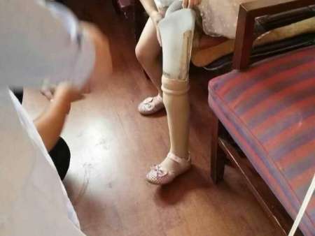 這個(gè)假肢，會(huì)比你的真腿管用！|新聞中心-山東菱康假肢矯形器有限公司
