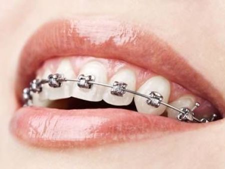 西安華創鎳鈦絲-形狀記憶合金應用之一：牙齒矯形