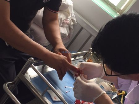 20180707痛风张先生手机痛风石处置