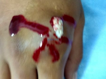 20180716痛风王先生治疗