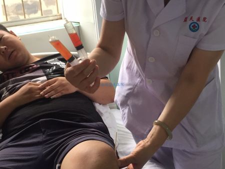 20180713痛风患者于先生抽积液