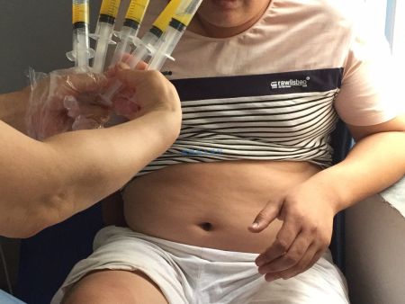 _20180726痛风王先生抽积液