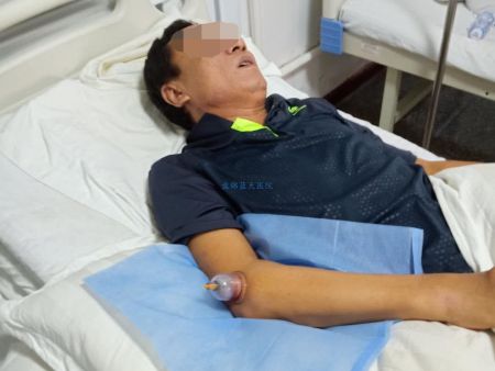 20180829痛风毕先生治疗