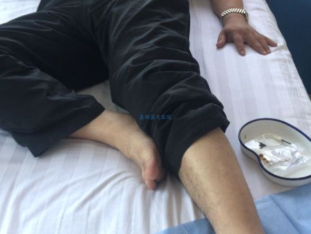 20180710痛风李先生处置