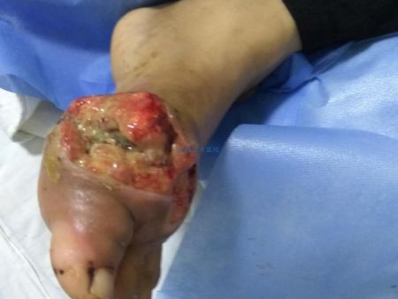 20180713痛风郭先生治疗