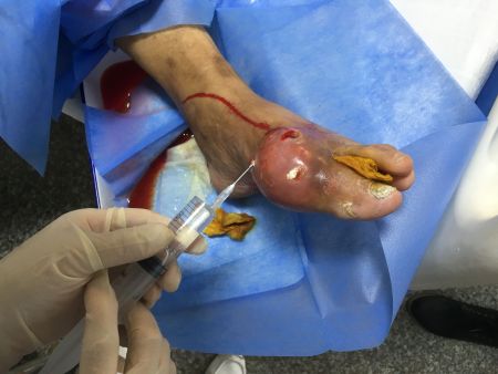 20181015痛风赵先生穴位注射