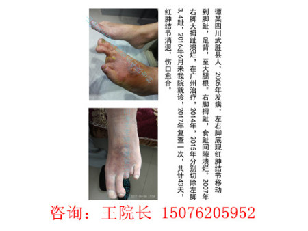 四川谭某前后对比