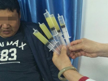 20181020华先生彩超引导下抽取积液