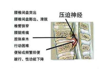 烟台腰椎间盘突出