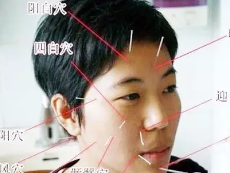 临沂面瘫治疗
