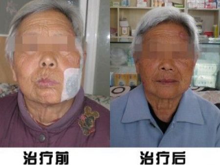临沂面瘫