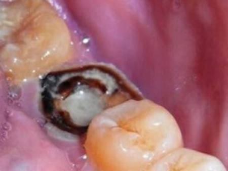 什么叫逆行性牙髓炎