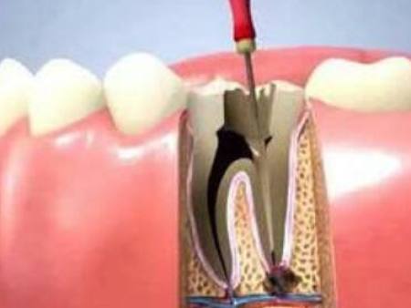 牙体牙髓病诊治