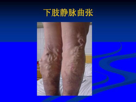 静脉曲张