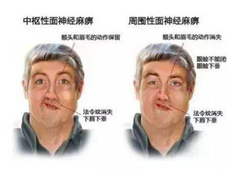面神经麻痹有哪些典型症状?