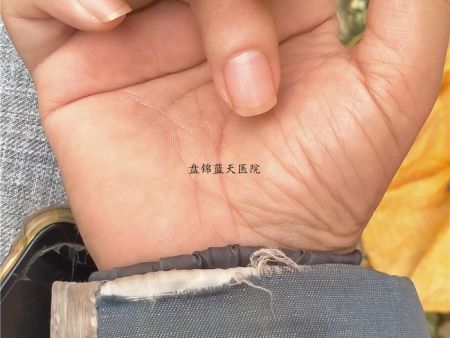 辽宁盘锦治痛风