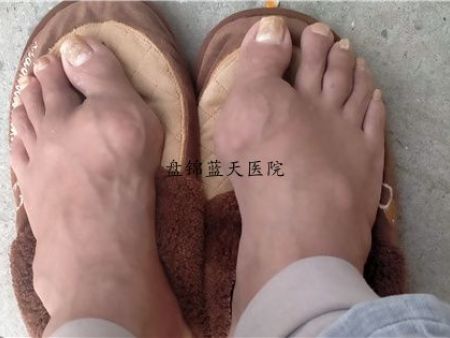 盘锦痛风好不好治