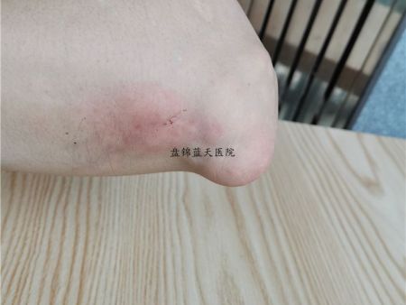 盘锦痛风哪家治得好