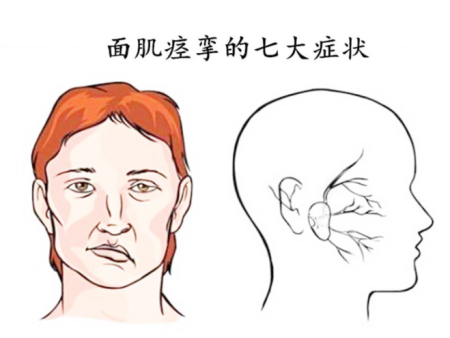 导致面肌痉挛发病的病因是什么？