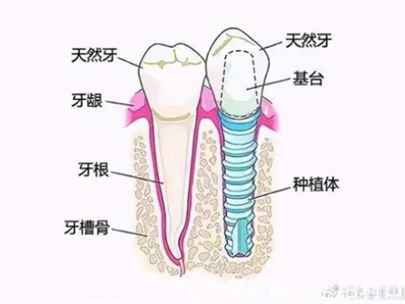 种植牙是什么？你想知道的都在这了