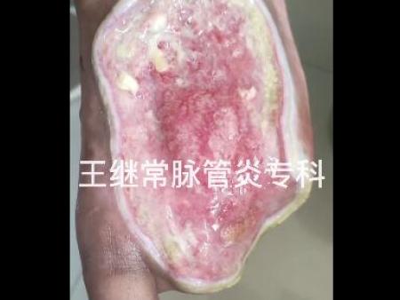 王继常脉管炎专科新入住患者治疗完一次的第二天拍摄视频