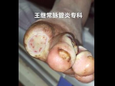 患者治疗完第二次伤口恢复情况