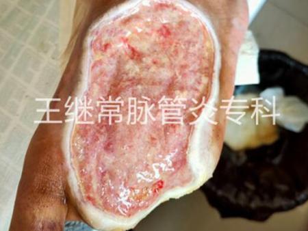 皮肤已经长出了健康的宽边