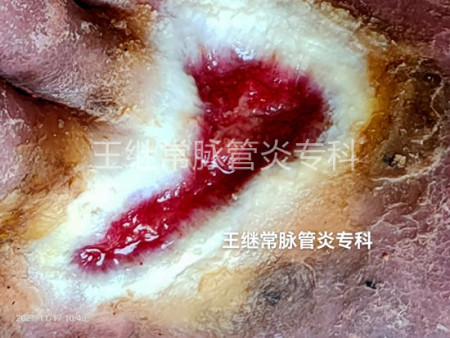 脉管炎引起的脚背部伤口新生中