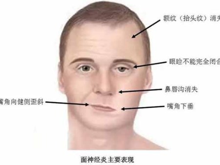 您对盘锦三叉神经痛这项疾病了解吗？