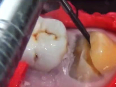 鲅鱼圈拔智齿