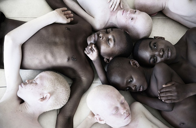 摄影师拍非洲白化病患呼吁破除迷信 因当地巫医残忍肢解白化病童