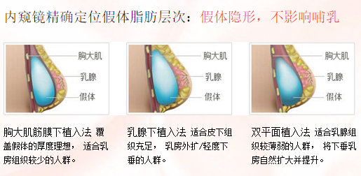 假体隆胸位置.png