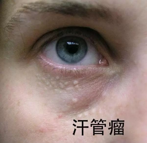 西安祛痣美——教你如何辨别脂肪粒,扁平疣,汗管瘤