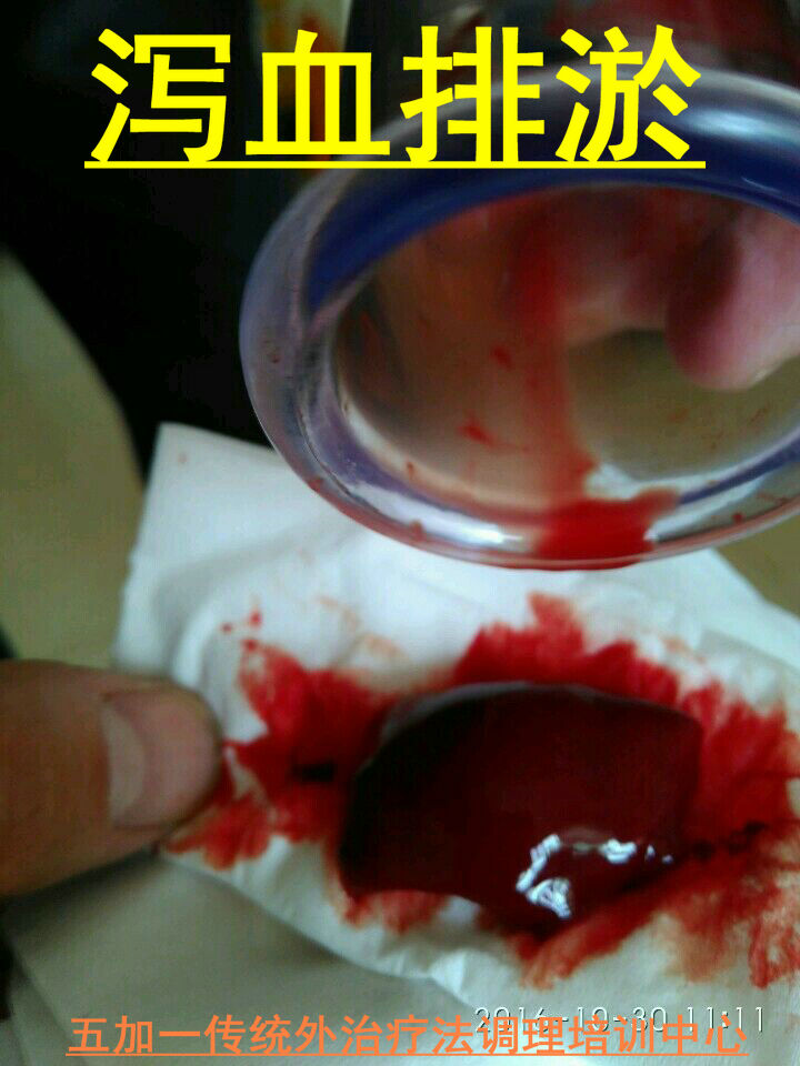 同时 泻血排瘀疗法具有很多的功效,可以对一些病症有很好的缓解和康复