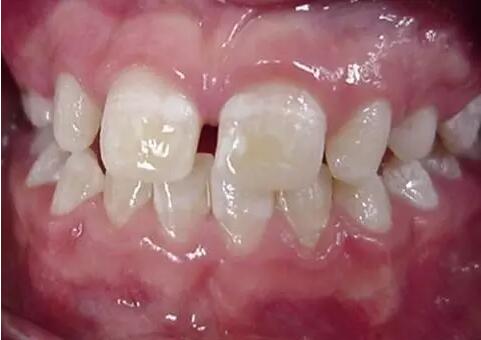 哪些原因可导致牙釉质发育不全