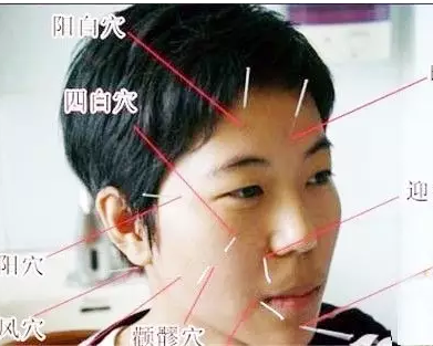 陈氏面瘫