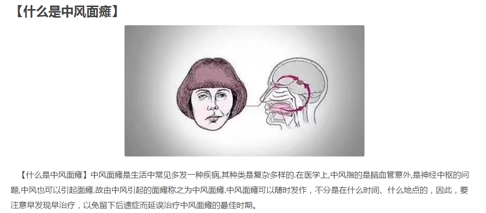 陈氏面瘫