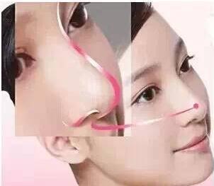 鼻翼整形
