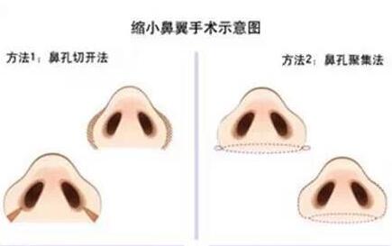 鼻翼整形