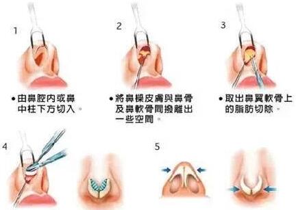 鼻翼整形