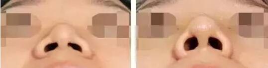 鼻小柱畸形和矫正方法