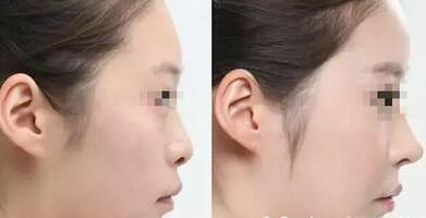 鼻小柱畸形和矫正方法