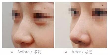 鼻小柱畸形和矫正方法