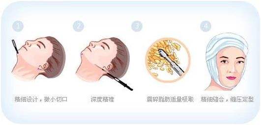 面部吸脂