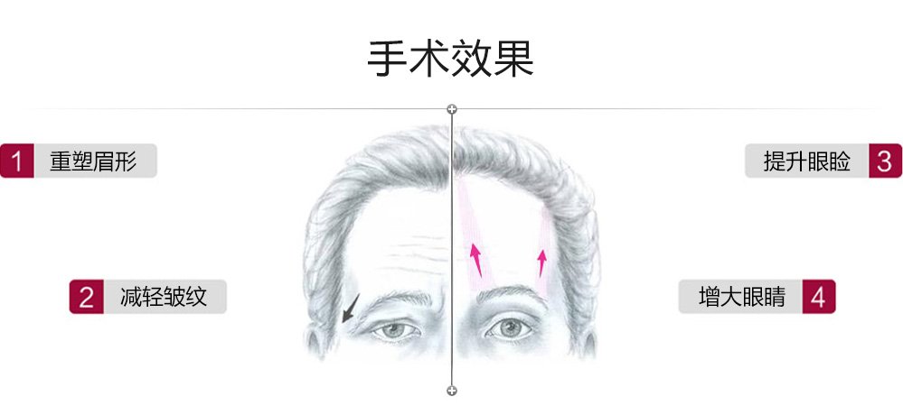 提眉手术