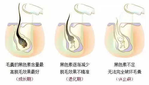 1572607180747284.png 腋下激光脱毛
