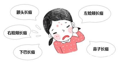 激光治疗痤疮