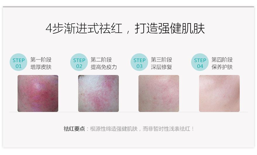 1572612683607110.jpg 激光去红血丝