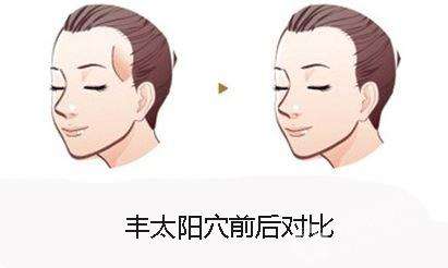 注射填充太阳穴