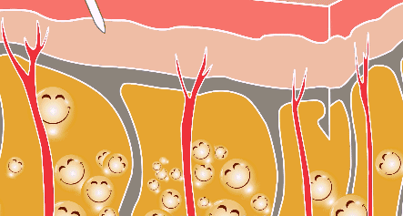 腰腹部吸脂减肥